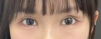 눈재수술 절개 눈매교정 뒷밑트임, 고민이 다 해결됐어요 — 아바성형외과 환자 후기 사진
