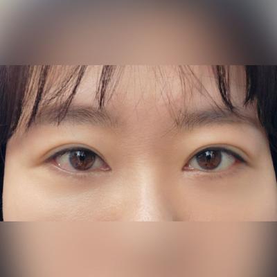 눈밑지방재배치 자가지방이식 2주차, 눈밑 완전 매끈해요 — 아바성형외과 환자 후기 사진