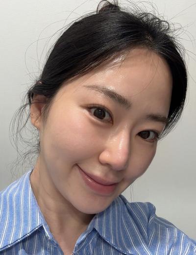 눈밑지방재배치 10주차, 짝짝이 정리되고 애교살도 살렸어요 사진 2 — 아바성형외과 눈밑지방재배치 후기