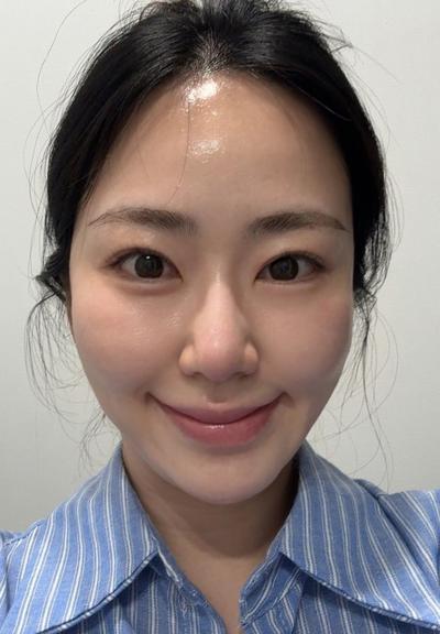 눈밑지방재배치 10주차, 짝짝이 정리되고 애교살도 살렸어요 사진 3 — 아바성형외과 눈밑지방재배치 후기