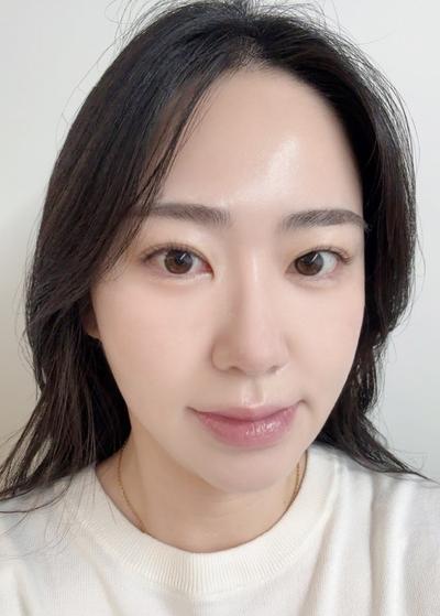 눈밑지방재배치 10주차, 짝짝이 정리되고 애교살도 살렸어요 사진 4 — 아바성형외과 눈밑지방재배치 후기