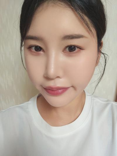 눈밑지방재배치 8주차, 짝짝이 정리되고 화장이 훨씬 편해요 — 아바성형외과 환자 후기 사진