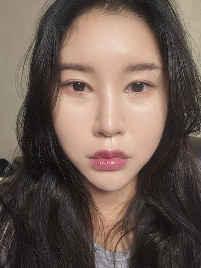 눈밑지방재배치 8주차, 짝짝이 정리되고 화장이 훨씬 편해요 사진 2 — 아바성형외과 눈밑지방재배치 후기