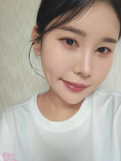 눈밑지방재배치 8주차, 짝짝이 정리되고 화장이 훨씬 편해요 사진 4 — 아바성형외과 눈밑지방재배치 후기