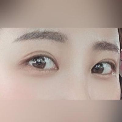 8주차, 젊어졌다는 말 들어요 새로운 삶 사는 기분 — 아바성형외과 환자 후기 사진