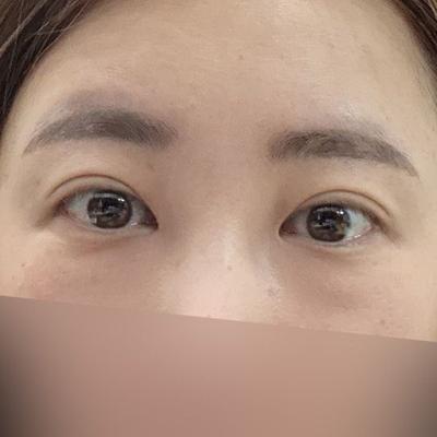 8주차, 젊어졌다는 말 들어요 새로운 삶 사는 기분 사진 2 — 아바성형외과 기타 후기