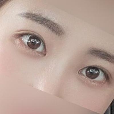 8주차, 젊어졌다는 말 들어요 새로운 삶 사는 기분 사진 4 — 아바성형외과 기타 후기