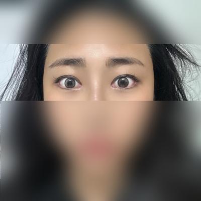 눈성형 12주차, 다들 진짜 예뻐졌다고 난리예요 — 아바성형외과 환자 후기 사진