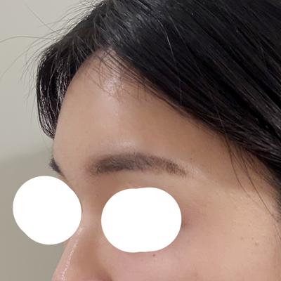 이마지방이식 4주차, 붓기 다 빠지고 인상이 부드러워졌어요 — 아바성형외과 환자 후기 사진