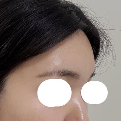 이마지방이식 4주차, 붓기 다 빠지고 인상이 부드러워졌어요 사진 4 — 아바성형외과 이마거상 후기