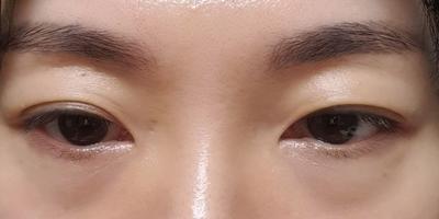 눈밑지방재배치＋뒤밑트임 재수술, 퀭한 느낌 완전 사라졌어요 — 아바성형외과 환자 후기 사진