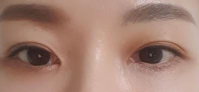 눈밑지방재배치＋뒤밑트임 재수술, 퀭한 느낌 완전 사라졌어요 사진 2 — 아바성형외과 눈밑지방재배치 후기