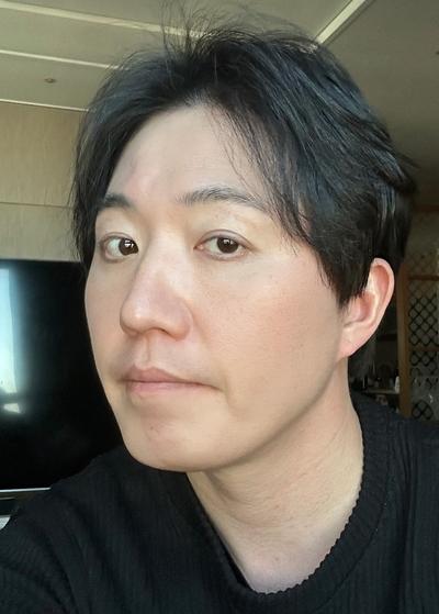 눈밑 시술 6주차, 붓기 없고 어려보인다는 말 들어요 — 아바성형외과 환자 후기 사진