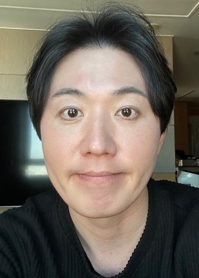 눈밑 시술 6주차, 붓기 없고 어려보인다는 말 들어요 사진 4 — 아바성형외과 눈밑지방재배치 후기