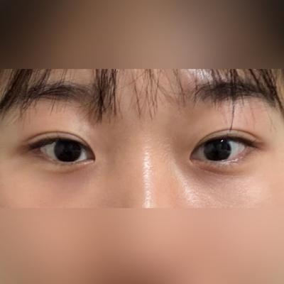 눈밑지방재배치 8주차, 날이 갈수록 만족해서 추천하고 싶어요 — 아바성형외과 환자 후기 사진