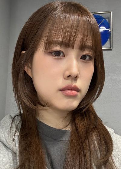 눈밑지방재배치 4주차, 다크서클 커버되고 안색 확 밝아졌어요 — 아바성형외과 환자 후기 사진