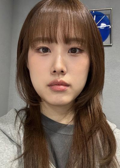 눈밑지방재배치 4주차, 다크서클 커버되고 안색 확 밝아졌어요 사진 5 — 아바성형외과 눈밑지방재배치 후기
