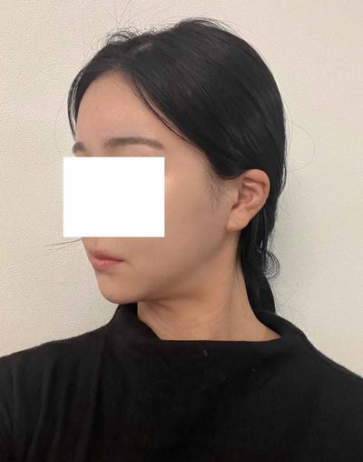 이중턱 시술 한달차, 이중턱 다 사라져서 스트레스 한방에 해결 — 아바성형외과 환자 후기 사진