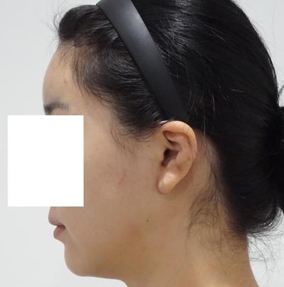 이중턱 시술 한달차, 이중턱 다 사라져서 스트레스 한방에 해결 사진 2 — 아바성형외과 이중턱·윤곽 후기