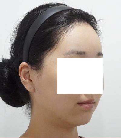 이중턱 시술 한달차, 이중턱 다 사라져서 스트레스 한방에 해결 사진 3 — 아바성형외과 이중턱·윤곽 후기