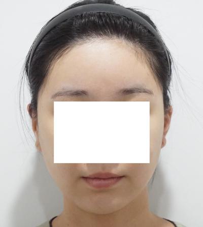 이중턱 시술 한달차, 이중턱 다 사라져서 스트레스 한방에 해결 사진 4 — 아바성형외과 이중턱·윤곽 후기