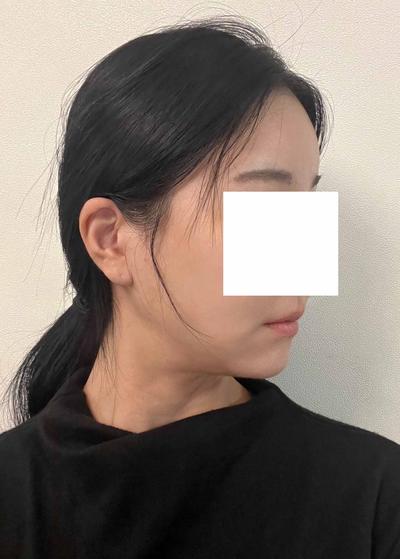 이중턱 시술 한달차, 이중턱 다 사라져서 스트레스 한방에 해결 사진 5 — 아바성형외과 이중턱·윤곽 후기