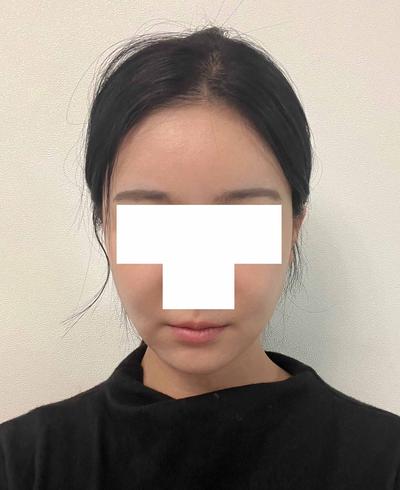 이중턱 시술 한달차, 이중턱 다 사라져서 스트레스 한방에 해결 사진 6 — 아바성형외과 이중턱·윤곽 후기