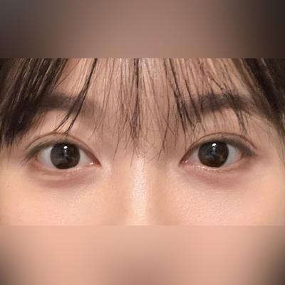 눈밑지방재배치 6주차, 피곤한 인상 이제 찾아볼 수 없어요 — 아바성형외과 환자 후기 사진