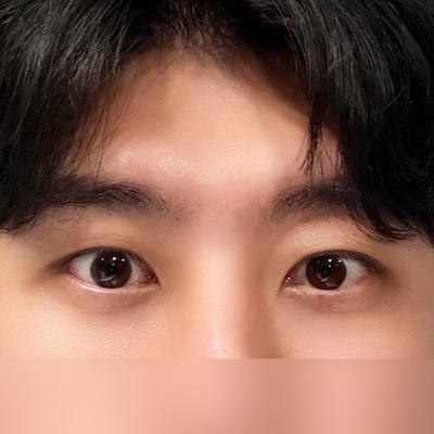 눈밑지방재배치 8주차, 5～6주차부터 불편함 완전 사라졌어요 — 아바성형외과 환자 후기 사진