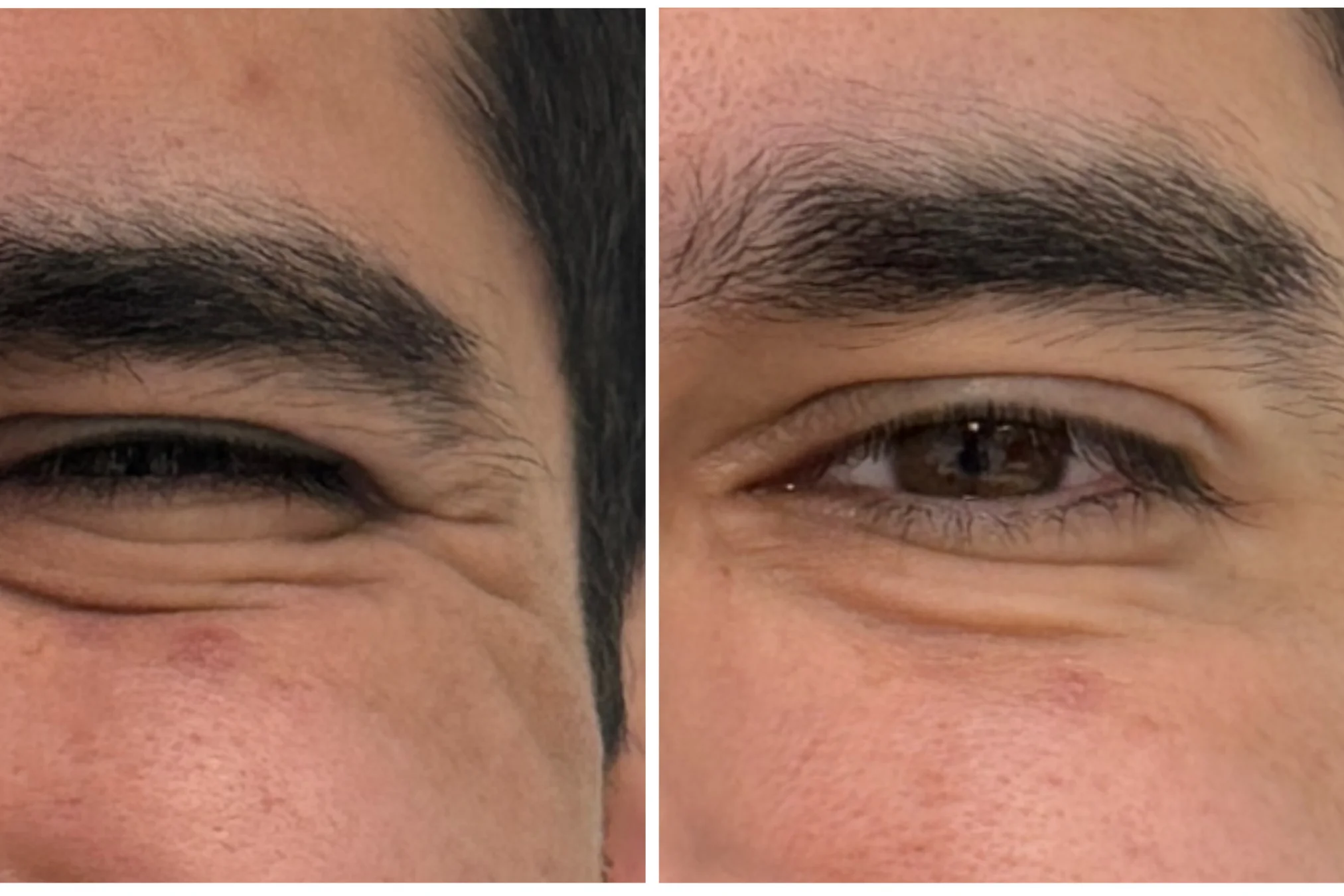 Resultado de Botox para Hombres (Botox)