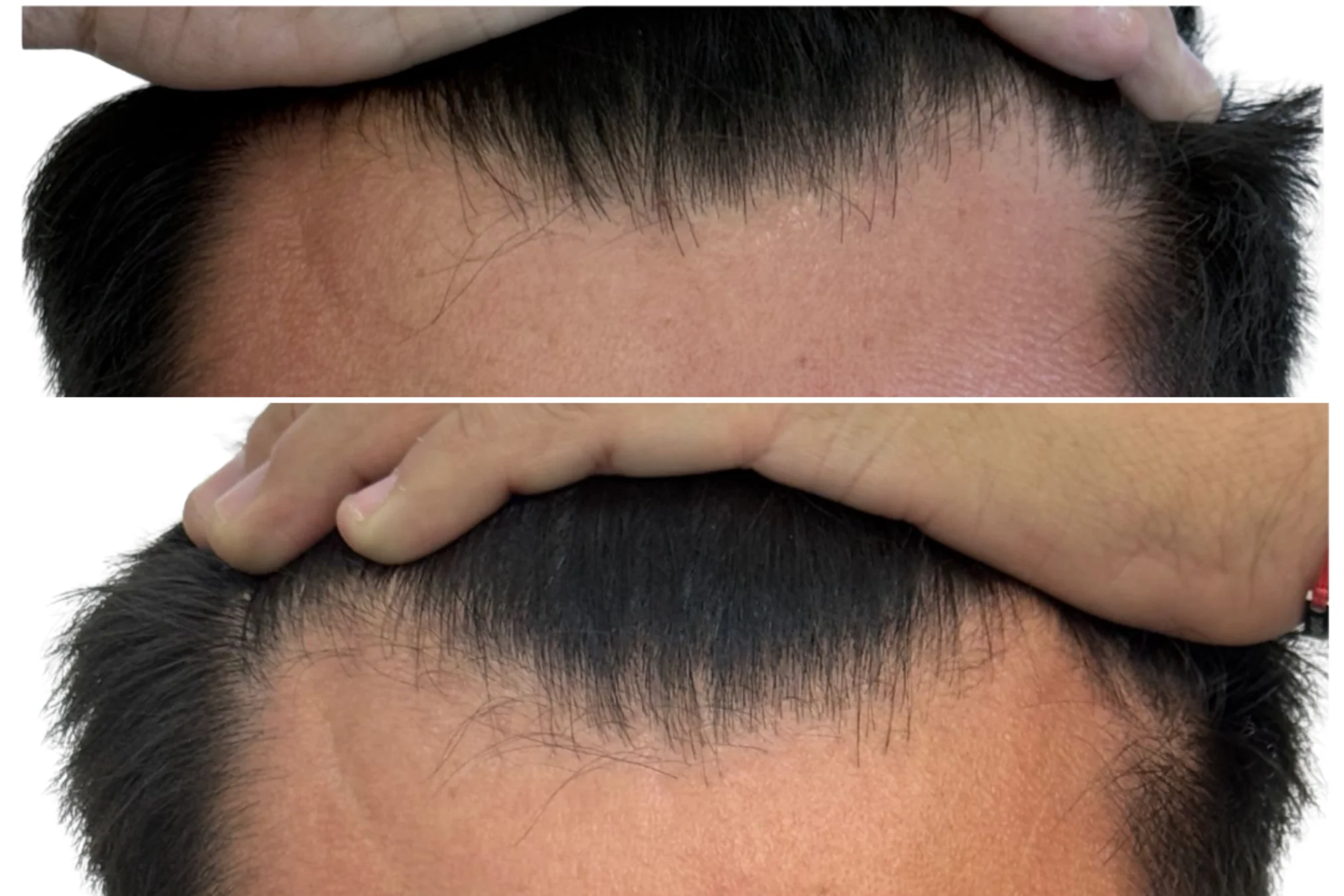 Resultado de Terapia Capilar Masculina