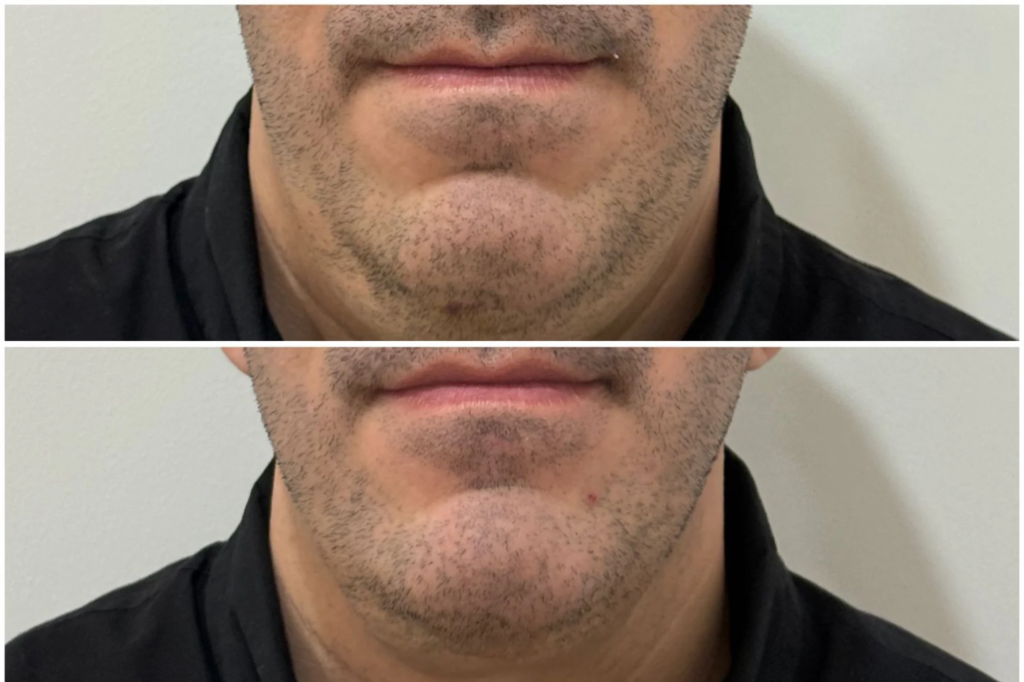 Resultado de Endolift Masculino