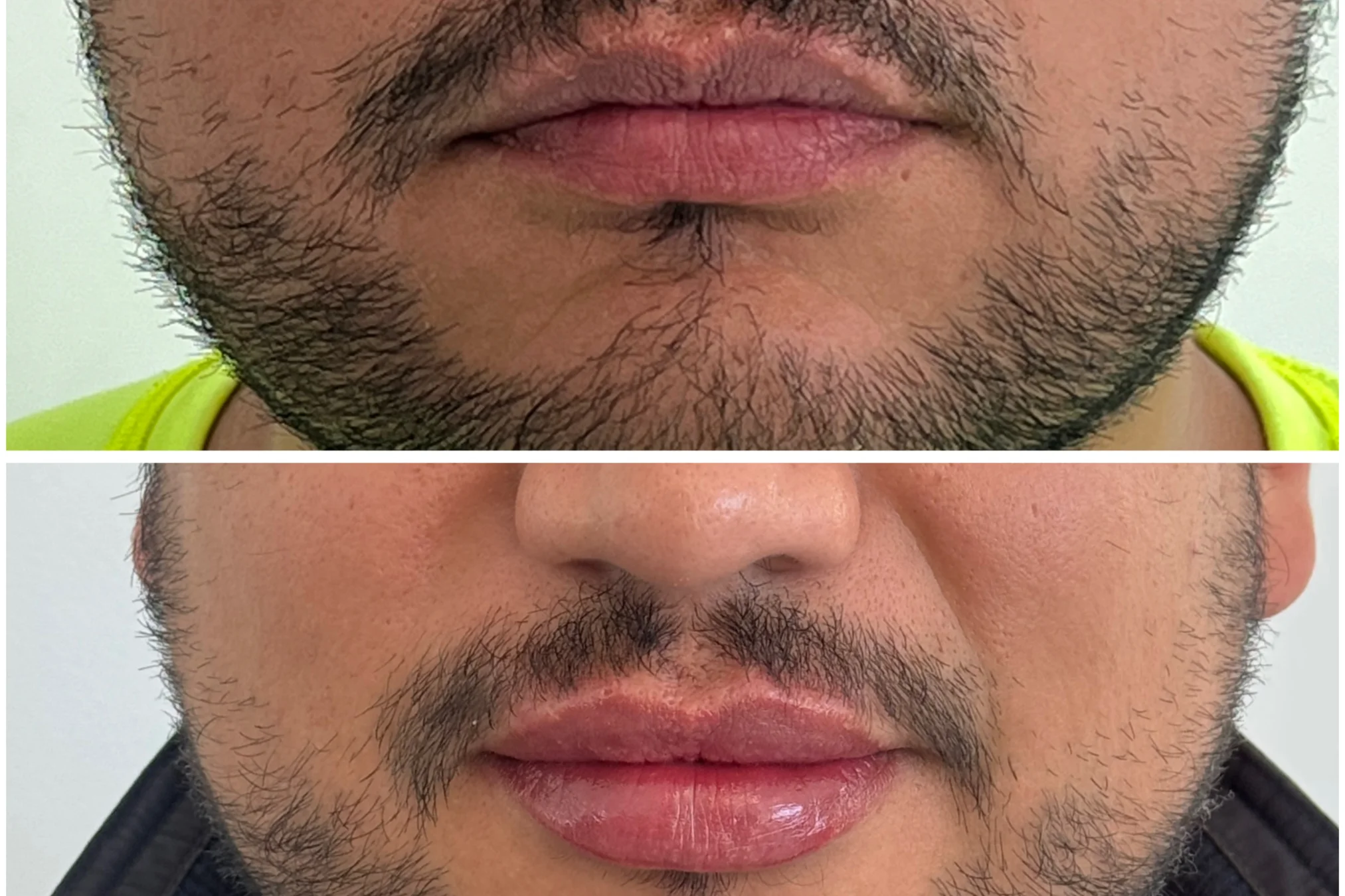 Resultado de Lip Filler para Él