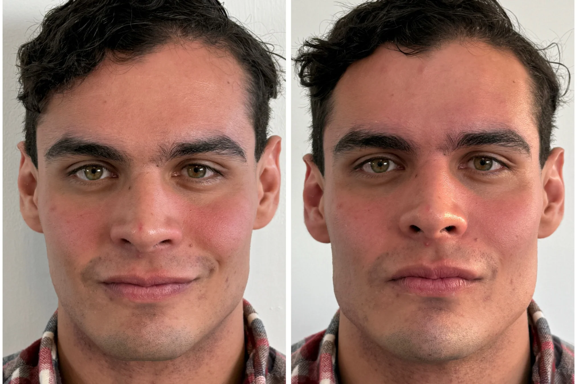 Resultado de Masculinización Facial