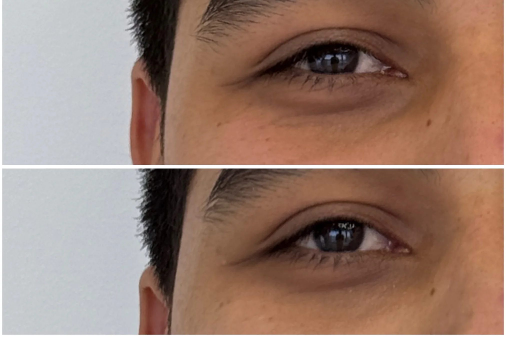 Resultado de Relleno de Ojeras