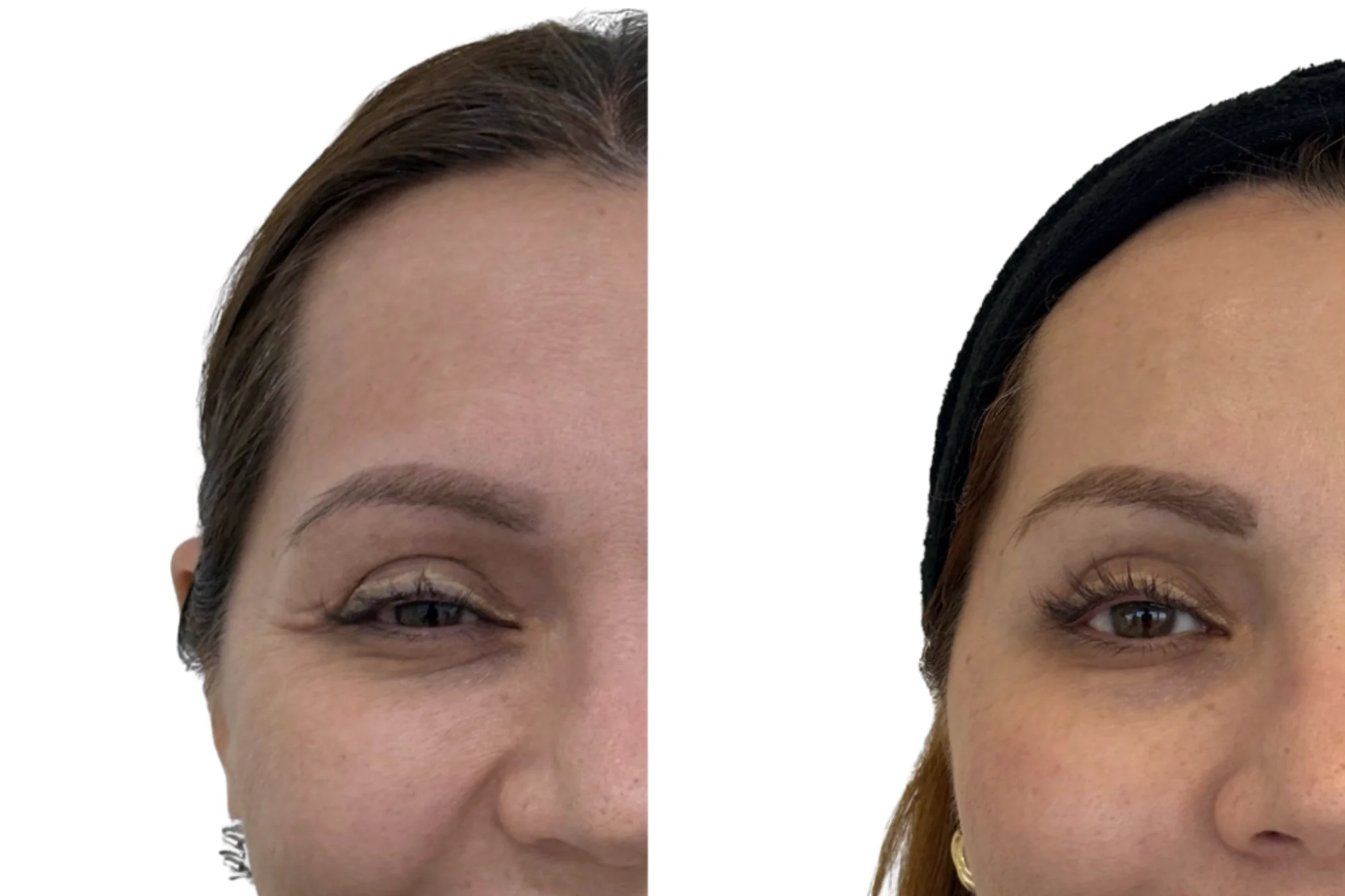 Antes y después de Botox para Mujeres (Botox) 1