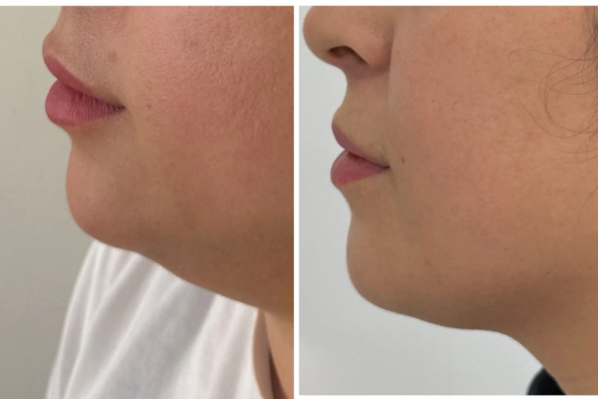 Resultado de Endolif (Lifting Láser/ Lipólisis Láser)