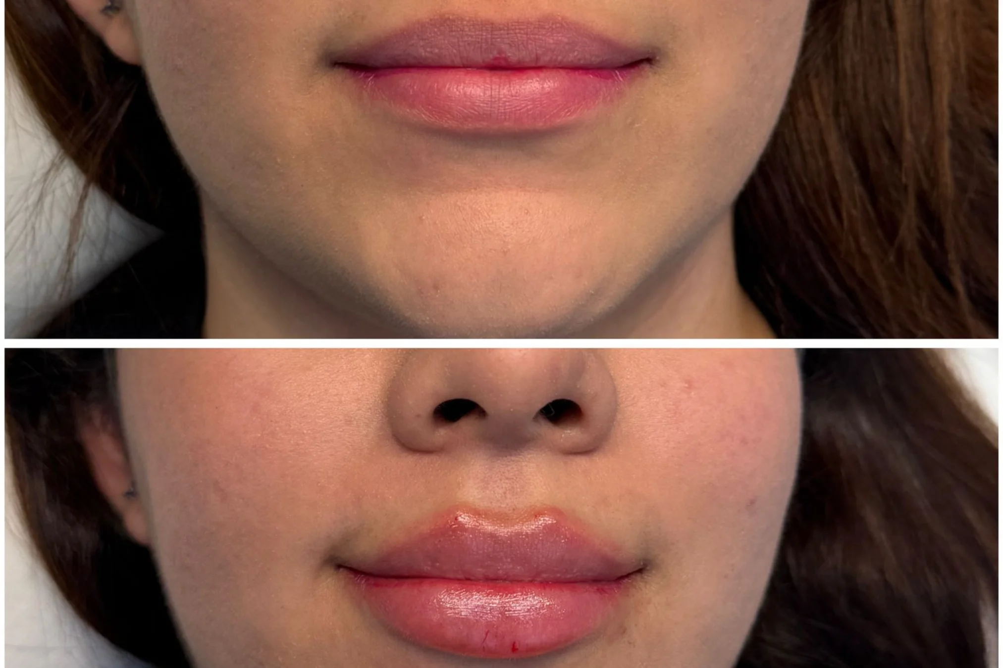 Antes y después de Lip Filler (Bioplastia Labial) 1