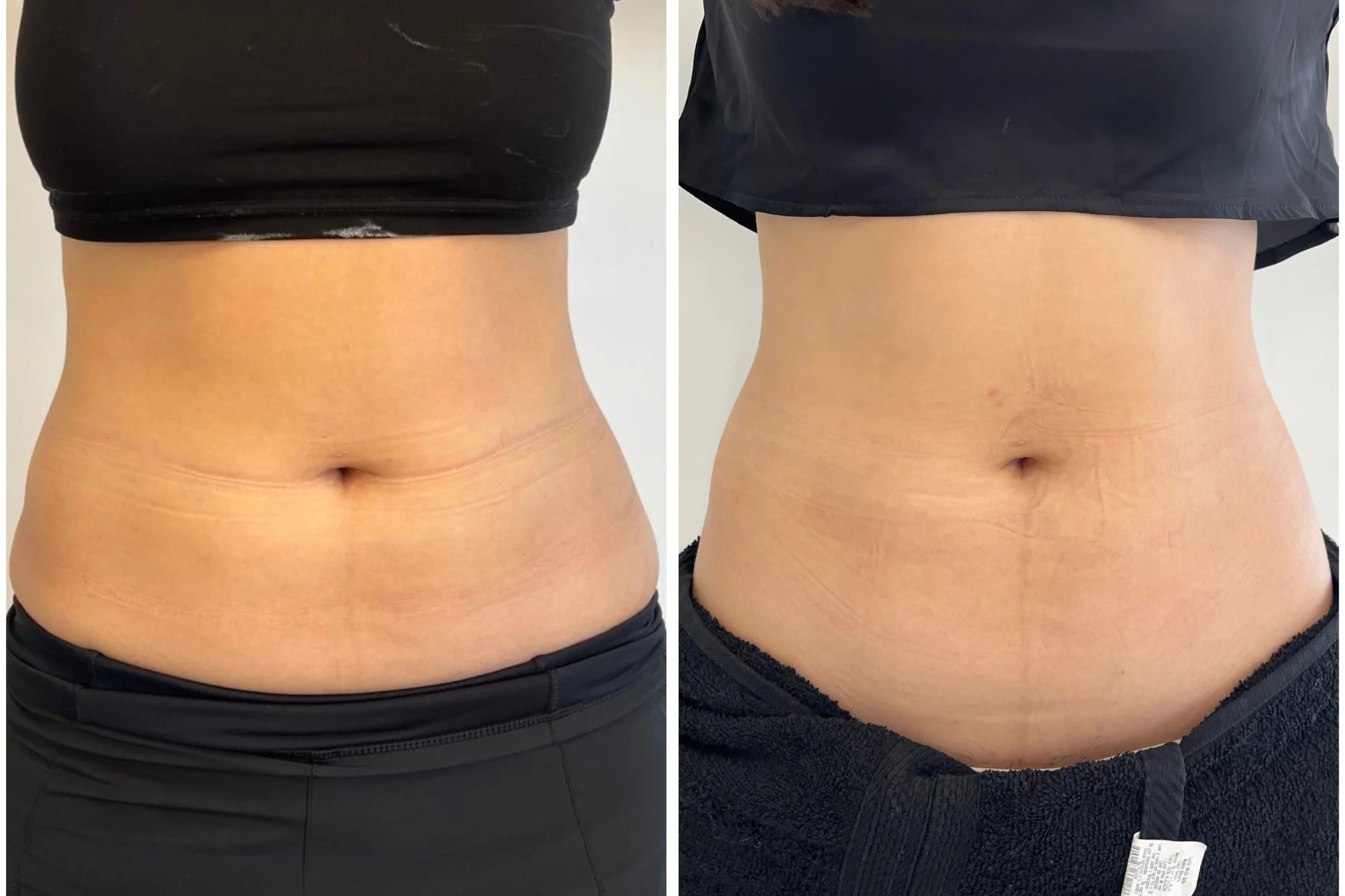 Antes y después de Lipoenzimas PB Serum 1