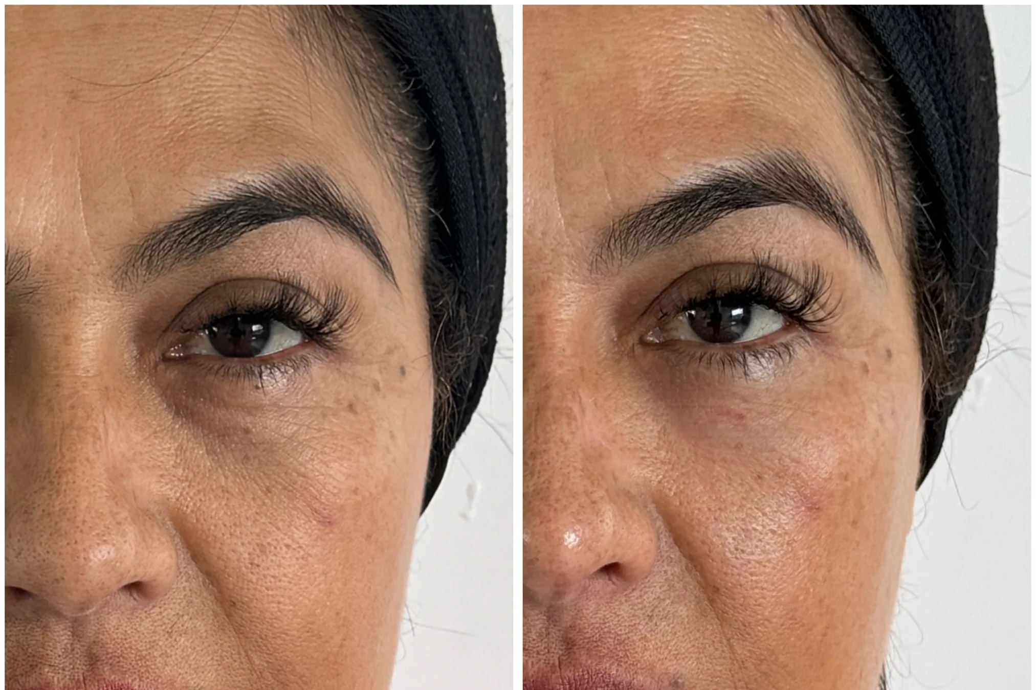 Resultado de Tratamiento de Ojeras