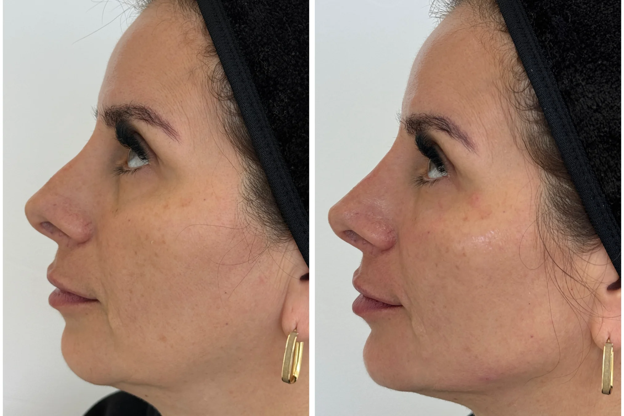 Resultado de Fillers