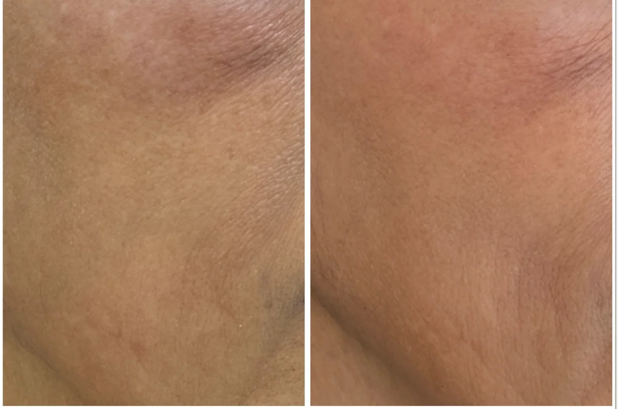 Resultado de Skinbooster (Hidratación Dérmica)