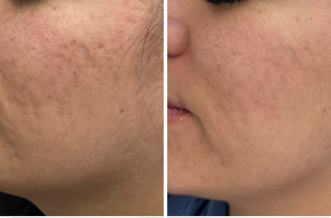 Resultado de Dermapen