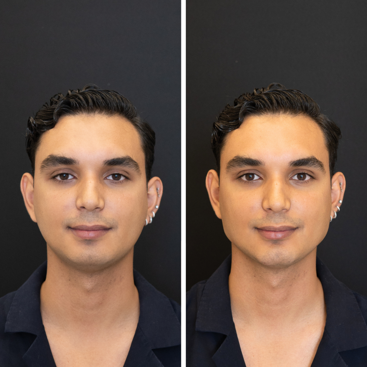 Armonización Facial Avoria