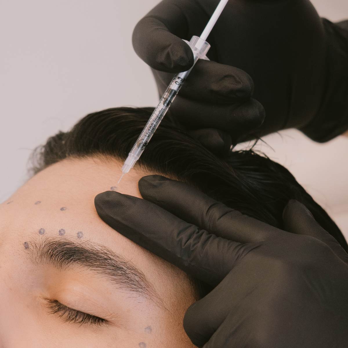 Botox para Hombres (Botox)