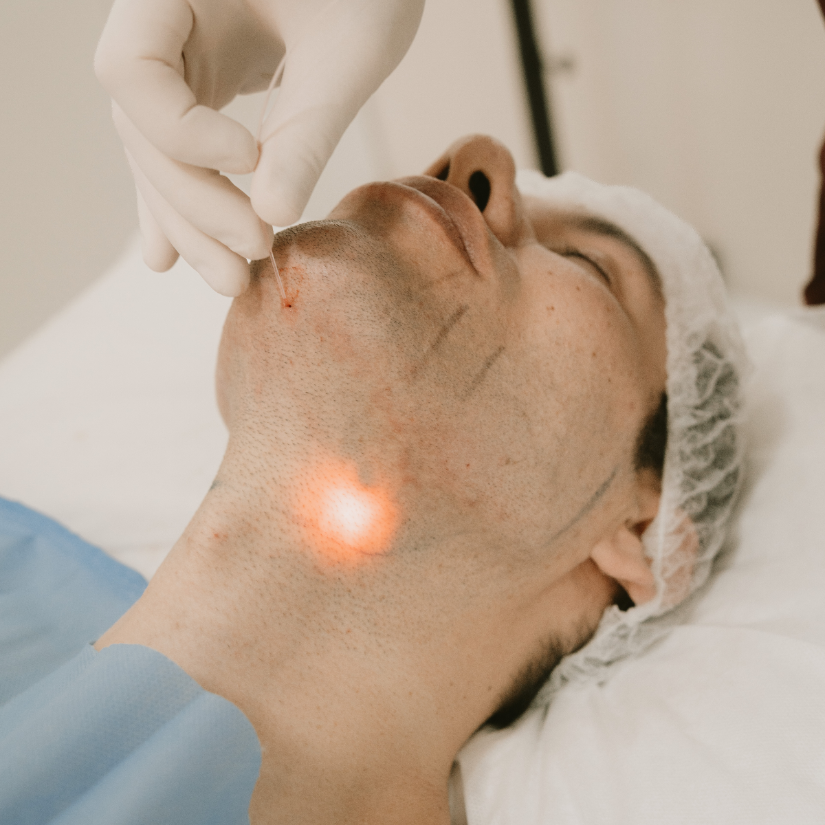 Endolift Masculino