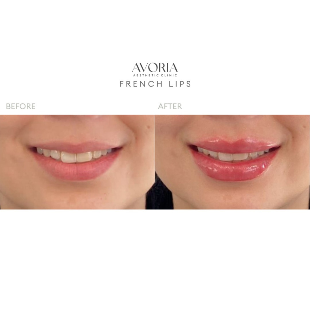 French Lips