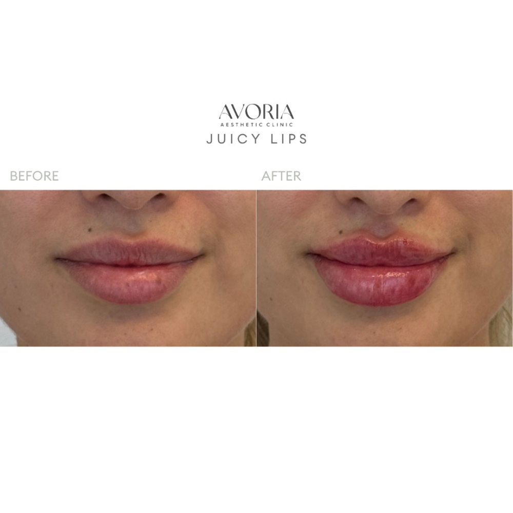 Juicy Lips