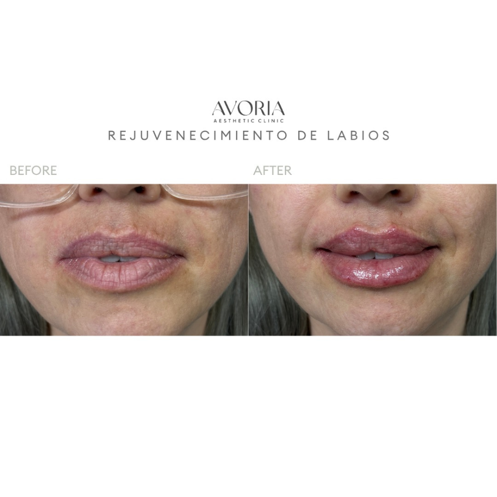 Rejuvenecimiento de Labios