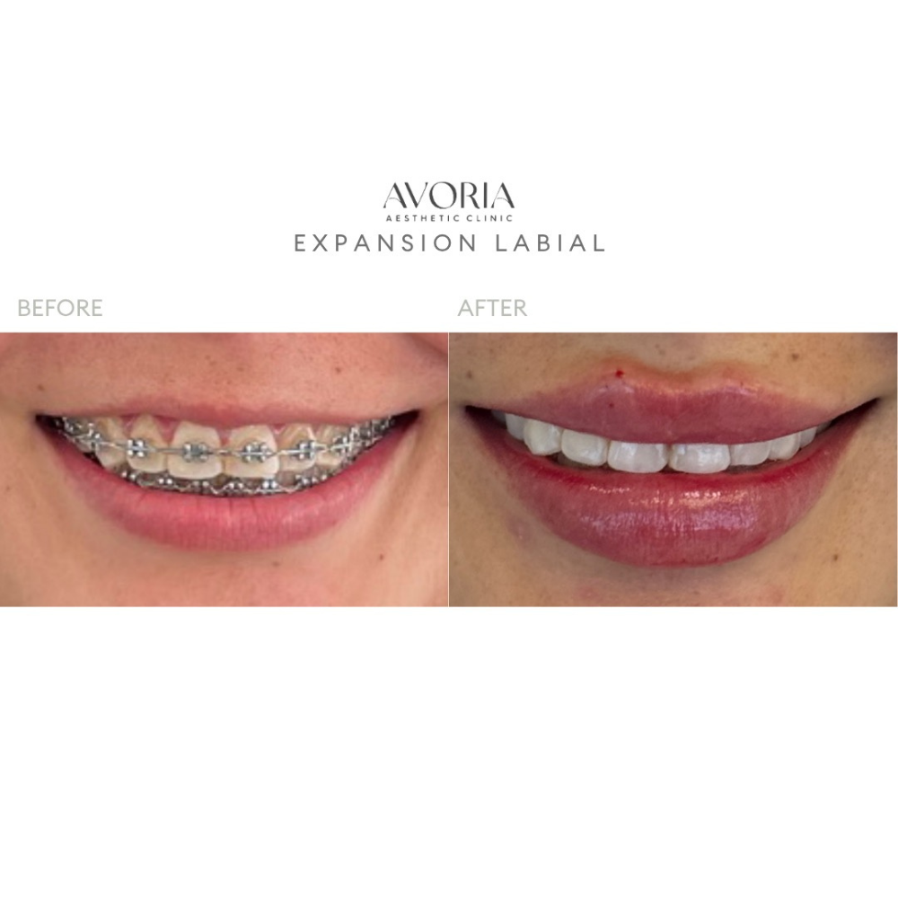Expansion Labial